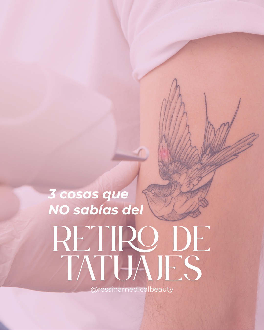 Retiro de tatuaje 1