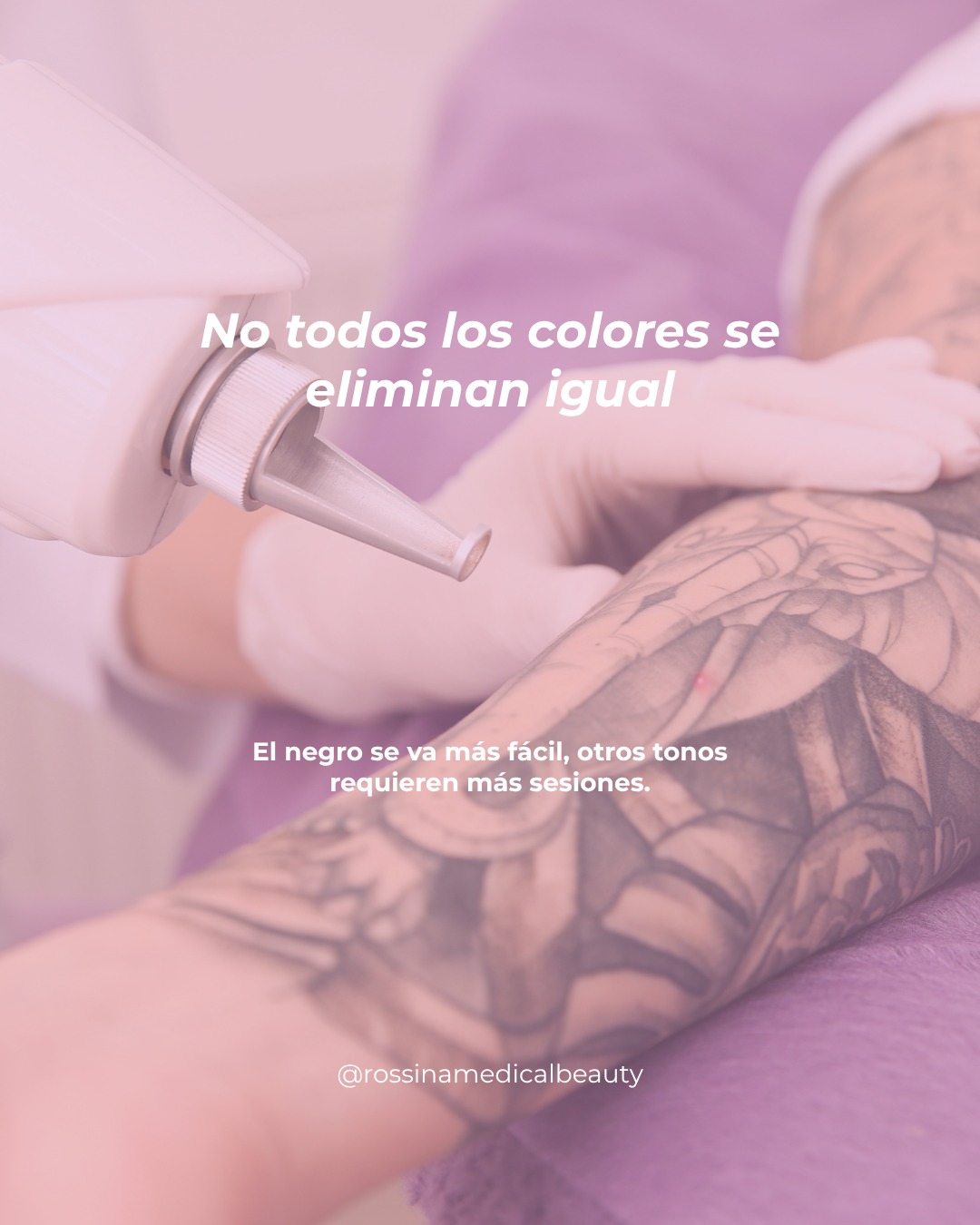 Retiro de tatuaje 3
