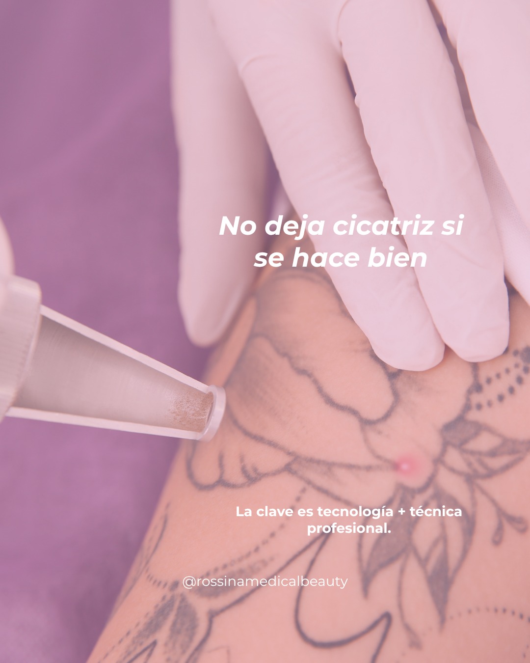 Retiro de tatuaje 4
